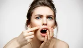 Top 7 mituri despre acnee: tipuri, cauze, tratament și prevenție