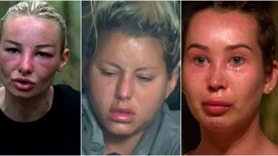 De ce li s-a umflat, de fapt, fața vedetelor de la „Survivor”? Adevărul din spatele transformărilor care au stârnit controverse