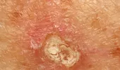 Carcinomul scuamos: cancerul de piele cu rată de vindecare 97%, dacă e depistat și tratat la timp