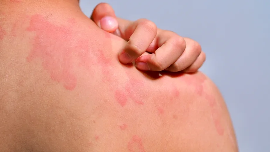 Urticaria: ce o declanșează și cum o ții sub control cu remedii naturiste