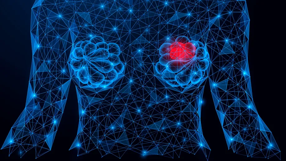 Ce sunt chisturile mamare și de ce sunt femeile cu sâni mici mai predispuse la apariția acestora