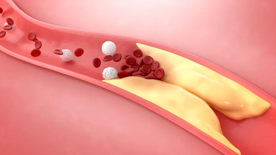 Colesterolul crescut la bărbați. Semnele ușor de identificat