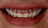 Gingivectomia sau corectarea zâmbetului gingival – în ce constă procedura?