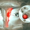 Peste 40% dintre femeile cu cancer ovarian află diagnosticul abia după o urgență medicală. Simptome pe care nu trebuie să le ignori, de la balonare persistentă, la urinări frecvente