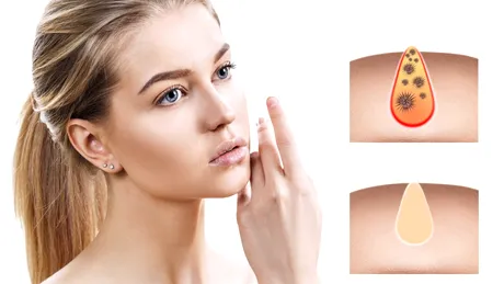 (P) Când porii dilatați nu se rezolvă cu exfoliere: greșeli frecvente în rutină