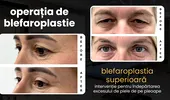 (P) Blefaroplastia superioară: de ce a devenit operația de pleoape cea mai realizată intervenție estetică din lume