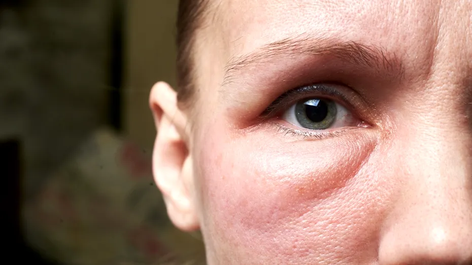 Semnele ascunse ale problemelor renale. Ce spun ochii umflați