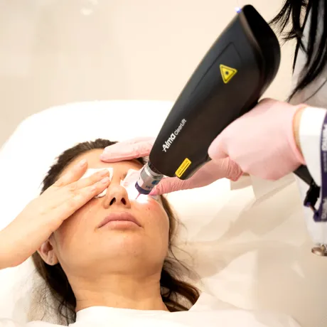 Melasma: petele pigmentare care se intensifică vara și pot fi tratate eficient toamna