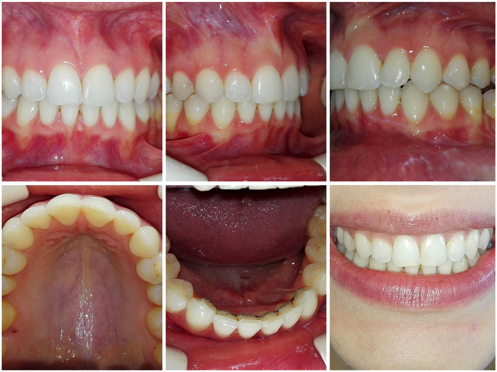 Rezultate zâmbet gingival după tratament