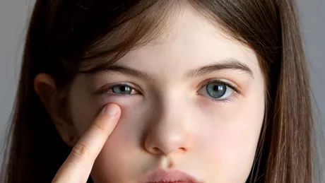 Ochi umflați din cauza alergiilor: cum să previi și să tratezi