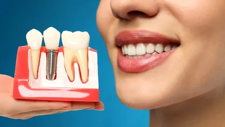 Implantul dentar, cea mai modernă și eficientă cale pentru înlocuirea dinților pierduți