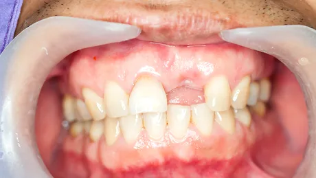 Cum se desfășoară procesul de adiție osoasă și ce contraindicații există