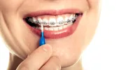 Igiena aparatului dentar – cum se face periajul și ce alimente trebuie evitate