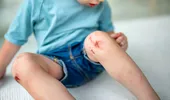O simplă julitură se poate transforma într-o infecție periculoasă la copii. La ce trebuie să fie atenți părinții