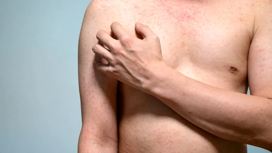 Dermatita atopică nu înseamnă doar piele uscată. Simptomul care poate afecta serios viața de zi cu zi