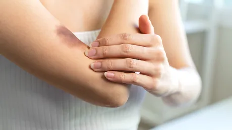 Ne trimit vânătăile la medicul hematolog?