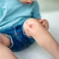 O simplă julitură se poate transforma într-o infecție periculoasă la copii. La ce trebuie să fie atenți părinții