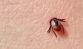 Un efect rar, dar grav al mușcăturii de căpușă. Sindromul care îi preocupă pe medici
