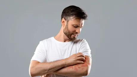 Cum scapi de mâncărime în dermatita atopică. Trucuri care calmează pielea