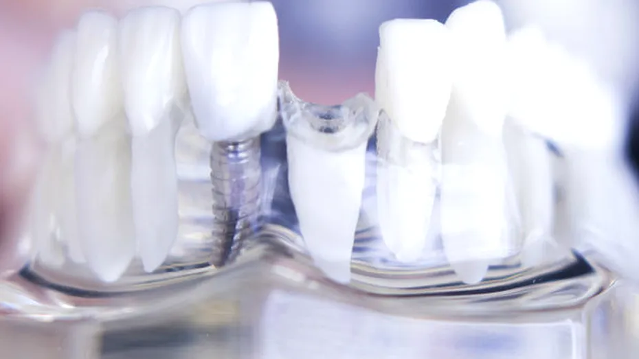 Cum ne poate afecta lipsa unui dinte aspectul feţei