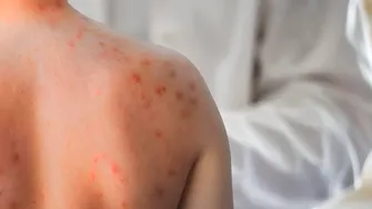 Descoperire majoră în lupta împotriva rujeolei. Cercetătorii au găsit anticorpi capabili să prevină și să trateze infecția