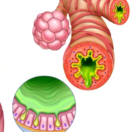 Inflamația cronică: „dușmanul invizibil” al sănătății moderne