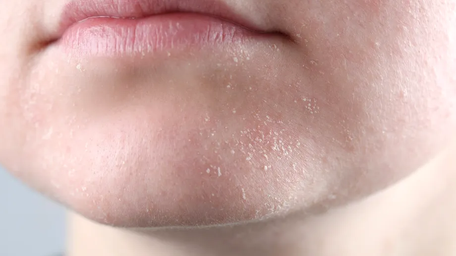 5 semne că pielea e deshidratată. Cum repari tenul după expunerea la soare