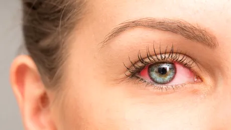 Melanomul ocular poate imita o infecție. Care sunt semnele și cum se tratează