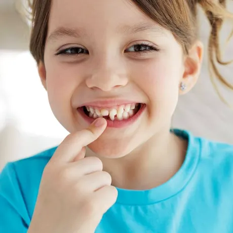 Transpoziția dentară la copii: ce înseamnă, de ce apare și când e nevoie de tratament?