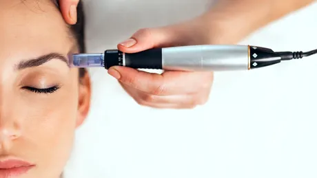 Inovație în rejuvenarea pielii prin microneedling cu radiofrecvență fracționată