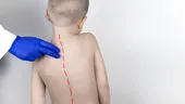 Cum putem identifica scolioza la copii. Primele semne ale afecțiunii