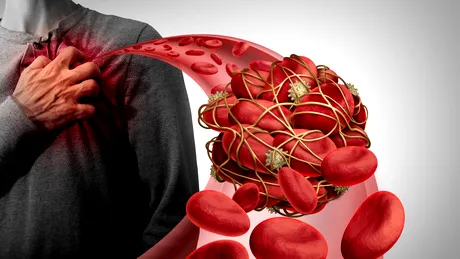 10 alimente și suplimente care subțiază sângele și reduc riscul de cheaguri