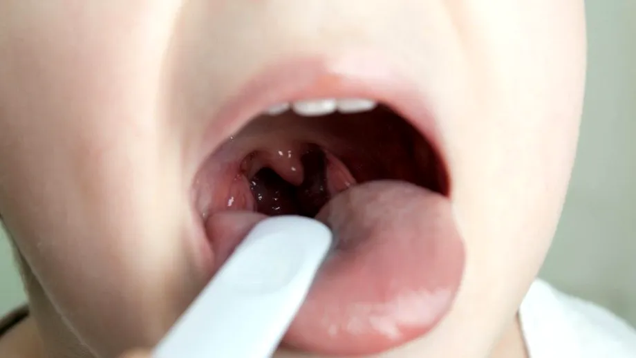 Ce semne și complicații dă infecția cu streptococ betahemolitic de grup A la copii