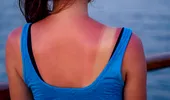 Arsurile solare nu sunt inofensive. Cinci episoade pot crește semnificativ riscul de cancer de piele