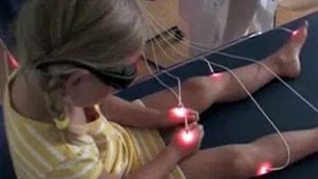 Acupunctura inlocuita cu razele laser!