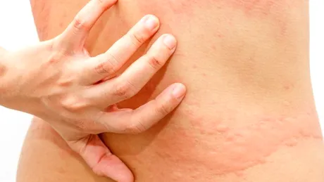 Urticaria la presiune: cauze, simptome, tratament