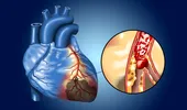 Simptomele preinfarctului – le cunoști? Tratează-te, altfel riști să faci un cheag la inimă!