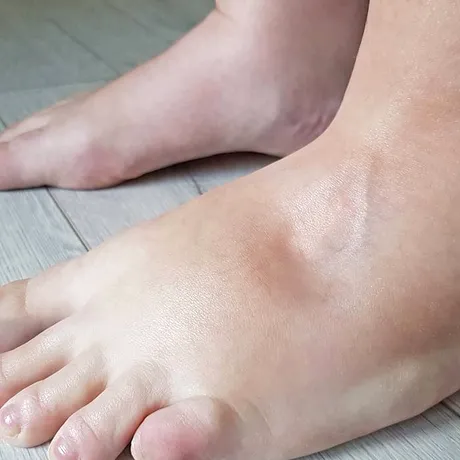 Cum să scapi de retenția de apă după ce ai mâncat prea sărat. Amestecul natural care acționează imediat