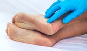 Semn neobișnuit la nivelul picioarelor care ar putea indica probleme hepatice. Medic: „Ficatul transmite semnale prin piele”