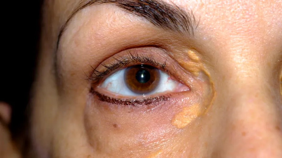 Semne care apar în jurul ochilor atunci când ai colesterolul crescut. 3 indicii că ai LDL mărit