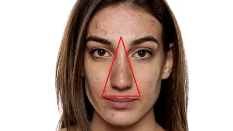 La ce pericol te expui dacă storci coșurile din „triunghiul morții”, o zonă foarte sensibilă de pe față