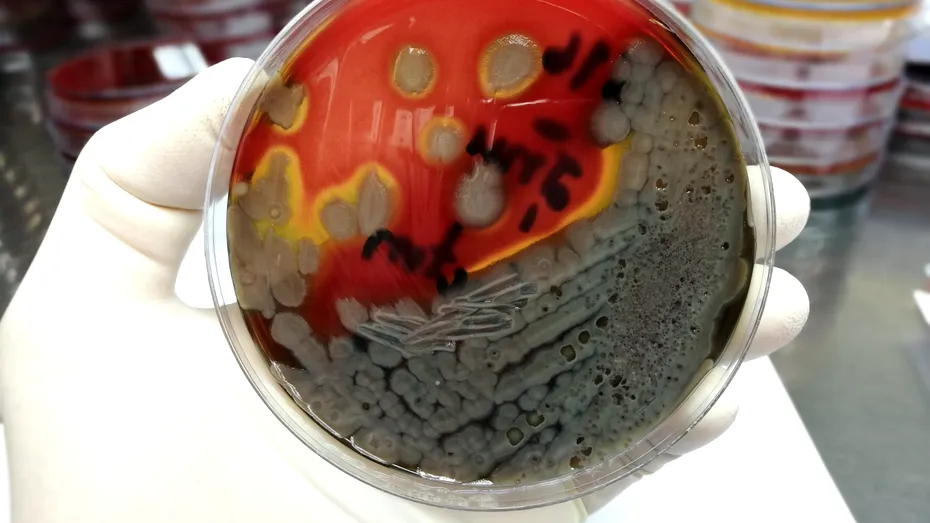 Bacteria mortală din spitale și piscine. Ce semne dă infecția cu bacilul piocianic