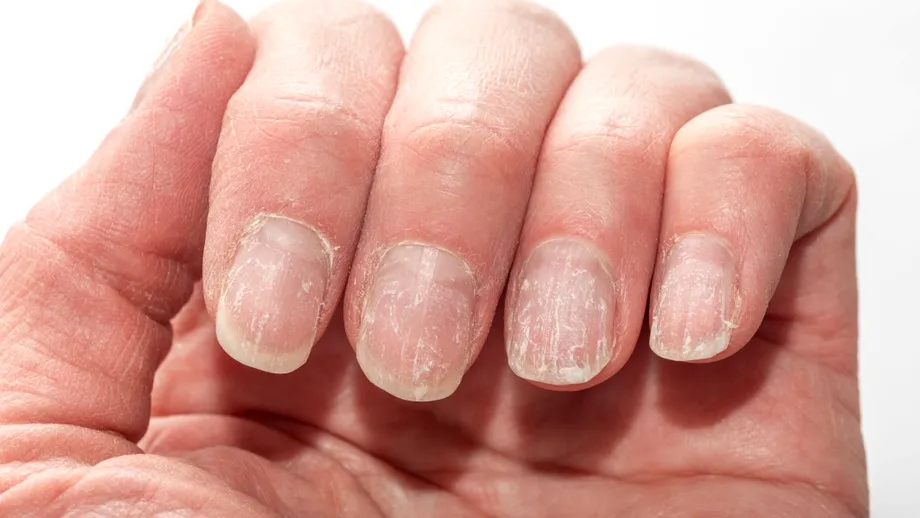 Unghiile pot semnala boli grave. Semnul discret care poate indica probleme ale inimii, ficatului sau rinichilor