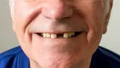 Implant sau punte dentară - care este cea mai bună soluție dacă ai pierdut un dinte?