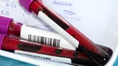 Ce analize de sânge pot arăta daca diabetul a afectat deja rinichii
