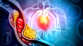 Poți face infarct chiar dacă ai colesterolul normal? Ce spun medicii despre riscul pe care analizele nu îl arată