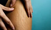 Ce să aplici pe piele să reduci vergeturile. 3 ingrediente de succes recomandate de dermatolog