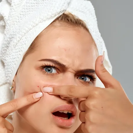 Ai puncte albe pe față? Iată ce sunt și de ce NU trebuie să le storci