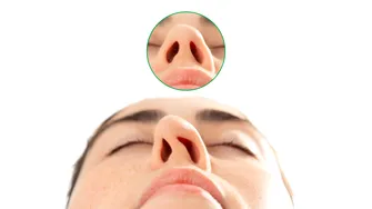 Rinoseptoplastia, operația 2 în 1: corectează aspectul nasului și deviația de sept