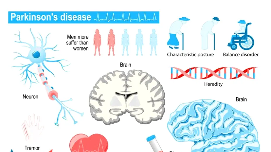 Povara bolii Parkinson afectează peste 72.000 de pacienţi în România
